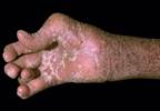 Apremilast Monotherapy Effective for DMARD-Naive Psoriatic Arthritis Apremilast Monotherapy Effective for DMARD-Naive Psoriatic Arthritis