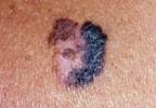 Melanoma, Nonmelanoma Skin Cancer Associated With Reduced Risk for Alzheimer's Melanoma, Nonmelanoma Skin Cancer Associated With Reduced Risk for Alzheimer's