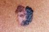 High Melanoma Care Costs With Ipilimumab High Melanoma Care Costs With Ipilimumab