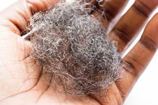 Researchers suggest that dermatologists screen for symptoms of uterine leiomyomas in patients with centrifugal cicatricial alopecia and encourage evaluation if appropriate. Researchers suggest that dermatologists screen for symptoms of uterine leiomyomas in patients with centrifugal cicatricial alopecia and encourage evaluation if appropriate.