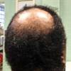 DermDx: Progressive Alopecia in the Mid-Scalp DermDx: Progressive Alopecia in the Mid-Scalp