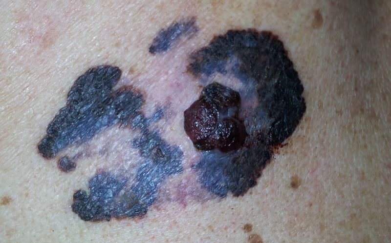 teledermatology-could-expedite-care-for-suspected-skin-cancer