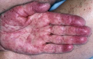 During the first year of treatment with pyrimethamine and sulfadiazine, the infant did not experience any signs of Stevens-Johnson syndrome or toxic epidermal necrolysis. During the first year of treatment with pyrimethamine and sulfadiazine, the infant did not experience any signs of Stevens-Johnson syndrome or toxic epidermal necrolysis.
