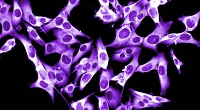 Desmoplastic Melanomas Have High Response Rate to PD-1 Blockade Desmoplastic Melanomas Have High Response Rate to PD-1 Blockade