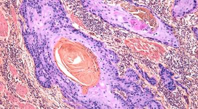 Dermoscopic Criteria for Diagnosing Melanoma in Situ Identified Dermoscopic Criteria for Diagnosing Melanoma in Situ Identified