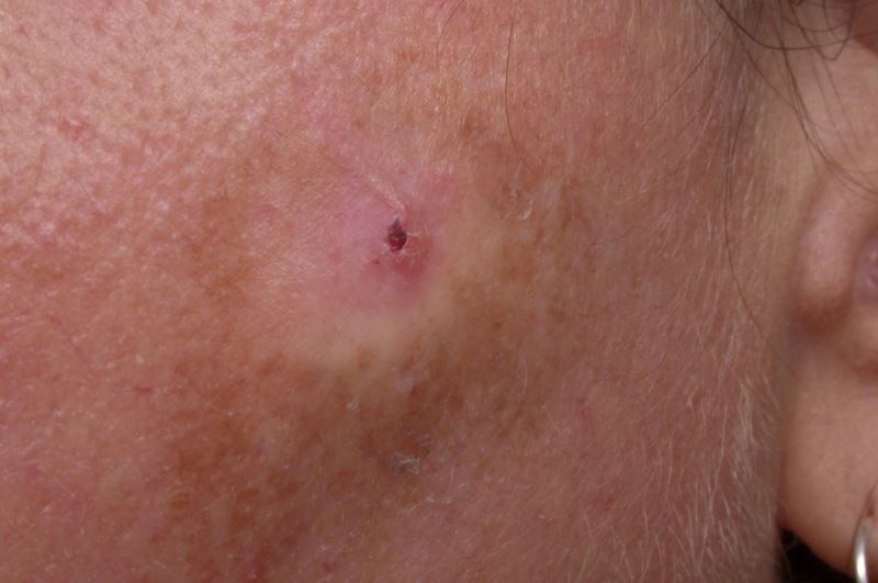 treatment cancer skin 5-fu Topical Keratosis Reduced With Recurring Actinic