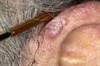 Increased Risk for Skin Cancer Among HIV-Infected Individuals Increased Risk for Skin Cancer Among HIV-Infected Individuals