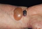 Bullous Pemphigoid Risk in Patients With Diabetes Treated With DPP-4 Inhibitors Bullous Pemphigoid Risk in Patients With Diabetes Treated With DPP-4 Inhibitors