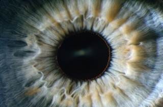 Iris pigmented lesion count provides predictive information for melanoma risk stratification. Iris pigmented lesion count provides predictive information for melanoma risk stratification.