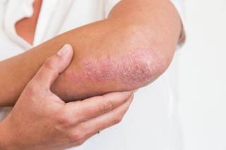 There was a 2.53-fold increased risk for developing Crohn disease and a 1.71-fold increased risk for developing ulcerative colitis. There was a 2.53-fold increased risk for developing Crohn disease and a 1.71-fold increased risk for developing ulcerative colitis.