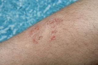 Concerns about appearance are among the top factors that affect health-related quality of life in patients with psoriasis. Concerns about appearance are among the top factors that affect health-related quality of life in patients with psoriasis.