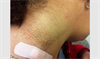 Clinical Challenge: Cutaneous Textural Changes on the Neck of a Middle-Aged Woman Clinical Challenge: Cutaneous Textural Changes on the Neck of a Middle-Aged Woman