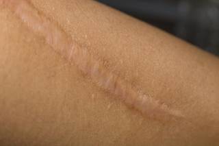The POSAS observer portion was utilized to assess for vascularity, pigmentation, thickness, surface area, relief, pliability, and overall opinion. The POSAS observer portion was utilized to assess for vascularity, pigmentation, thickness, surface area, relief, pliability, and overall opinion.