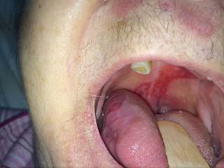 ODSS is easy to use and facilitates detailed recording of both the site and the severity of pemphigus vulgaris lesions. ODSS is easy to use and facilitates detailed recording of both the site and the severity of pemphigus vulgaris lesions.