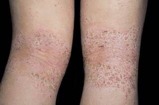 Treatment with lebrikizumab 125 mg Q4W regimen was associated with significant improvements in patients with moderate to severe atopic dermatitis. Treatment with lebrikizumab 125 mg Q4W regimen was associated with significant improvements in patients with moderate to severe atopic dermatitis.