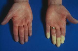 The results showed a moderate to large treatment effect in both primary and secondary Raynaud's phenomenon. The results showed a moderate to large treatment effect in both primary and secondary Raynaud's phenomenon.