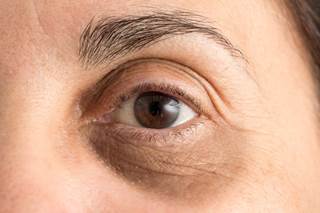 The overall mean patient satisfaction as measured by the FACE-Q Satisfaction With Eyes Survey was 71.1%. The overall mean patient satisfaction as measured by the FACE-Q Satisfaction With Eyes Survey was 71.1%.