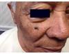 DermDx: Hispanic Man With Facial Lesion of Increasing Size DermDx: Hispanic Man With Facial Lesion of Increasing Size