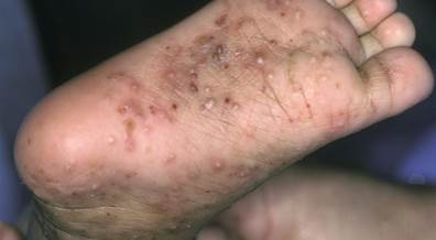 Limited Examination Detects Scabies With High Sensitivity Limited Examination Detects Scabies With High Sensitivity