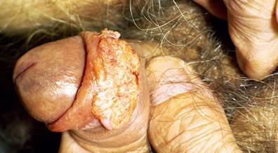 Genital Lesions Prevalent Among Solid Organ Transplant Recipients Genital Lesions Prevalent Among Solid Organ Transplant Recipients