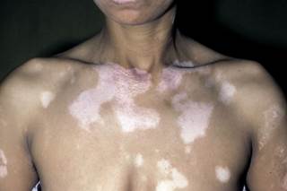 Disease activity in patients with vitiligo correlated with serum levels of homocysteine and vitamin B12. Disease activity in patients with vitiligo correlated with serum levels of homocysteine and vitamin B12.