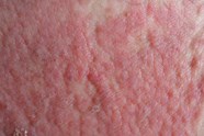 Concomitant Allergic Dermatitis Polysensitization Common In Tough to 