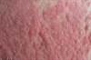 Atopic Dermatitis Associated With Impaired Quality of Life, Overall Health Atopic Dermatitis Associated With Impaired Quality of Life, Overall Health