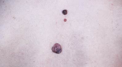 Sentinel Node Biopsy vs Breslow Thickness for Melanoma Prognosis: Which is Better? Sentinel Node Biopsy vs Breslow Thickness for Melanoma Prognosis: Which is Better?