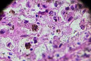 Specialty training and more experience interpreting melanocytic lesions was associated with reproducibility rates. Specialty training and more experience interpreting melanocytic lesions was associated with reproducibility rates.