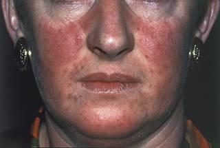 Clinicians should consider screening patients with rosacea for common comorbidities, ideally before considering treatment options. Clinicians should consider screening patients with rosacea for common comorbidities, ideally before considering treatment options.