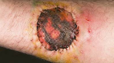 SLNBs Feasible After Wide Local Excisions in Melanoma of the Head and Neck SLNBs Feasible After Wide Local Excisions in Melanoma of the Head and Neck