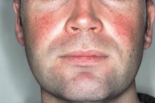 Rosacea more often is evident after the age of 30 years, peaking between the ages of 40 and 50 years. Rosacea more often is evident after the age of 30 years, peaking between the ages of 40 and 50 years.