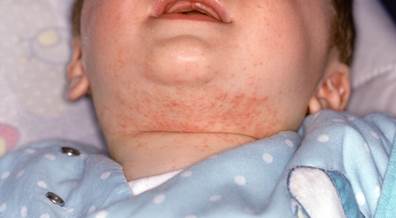 Genetics, Clinical Characteristics Tied to Atopic Dermatitis Persistence in Childhood Genetics, Clinical Characteristics Tied to Atopic Dermatitis Persistence in Childhood