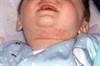 Genetics, Clinical Characteristics Tied to Atopic Dermatitis Persistence in Childhood Genetics, Clinical Characteristics Tied to Atopic Dermatitis Persistence in Childhood