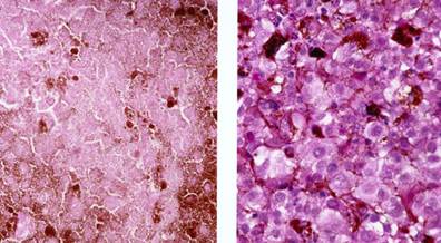 Tumor-Infiltrating Lymphocytes Predict Melanoma Prognosis in Men Tumor-Infiltrating Lymphocytes Predict Melanoma Prognosis in Men