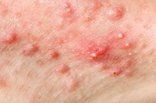 Combination therapy and oral isotretinoin are first-line treatment options for severe acne vulgaris. Combination therapy and oral isotretinoin are first-line treatment options for severe acne vulgaris.