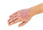 Psoriasis Treatment Ixekizumab Safe for Cardiovascular Health Psoriasis Treatment Ixekizumab Safe for Cardiovascular Health