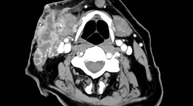 Adjuvant Pembrolizumab Beneficial in Stage III Melanoma Adjuvant Pembrolizumab Beneficial in Stage III Melanoma
