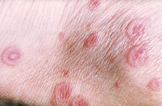 Carbamazepine, an anticonvulsant agent used for seizure control in patients with epilepsy, is known to be associated with cutaneous adverse reactions. Carbamazepine, an anticonvulsant agent used for seizure control in patients with epilepsy, is known to be associated with cutaneous adverse reactions.