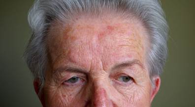 Once-Daily Topical Treatment Effective for Rosacea-Associated Facial Erythema Once-Daily Topical Treatment Effective for Rosacea-Associated Facial Erythema