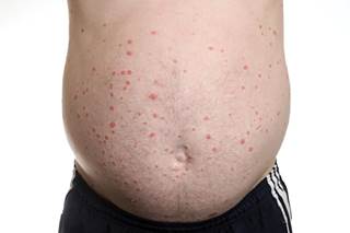 Dermatologists may be among the first clinicians to identify the precursors of type 2 diabetes and cardiovascular disease in patients who have comorbid skin disorders. Dermatologists may be among the first clinicians to identify the precursors of type 2 diabetes and cardiovascular disease in patients who have comorbid skin disorders.