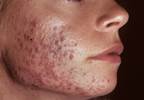 Hormonal Antiandrogen Therapy for Acne May Help Reduce Antibiotic Use Hormonal Antiandrogen Therapy for Acne May Help Reduce Antibiotic Use