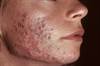 Hormonal Antiandrogen Therapy for Acne May Help Reduce Antibiotic Use Hormonal Antiandrogen Therapy for Acne May Help Reduce Antibiotic Use