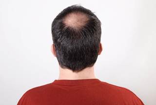 Minoxidil and oral finasteride are the only 2 FDA-approve therapies for androgenetic alopecia. Minoxidil and oral finasteride are the only 2 FDA-approve therapies for androgenetic alopecia.