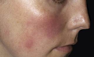 Patients with rosacea often have psychiatric comorbidities, social anxiety, and suffer from embarrassment. Patients with rosacea often have psychiatric comorbidities, social anxiety, and suffer from embarrassment.