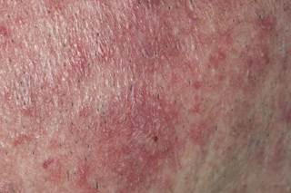 The investigators concluded that the results of this study imply that the use of CD-doxycycline may have an impact on the previously reported association between rosacea and GID. The investigators concluded that the results of this study imply that the use of CD-doxycycline may have an impact on the previously reported association between rosacea and GID.