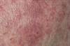 Oxymetazoline Reduces Facial Erythema in Moderate to Severe Rosacea Oxymetazoline Reduces Facial Erythema in Moderate to Severe Rosacea