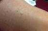 DermDx: Flesh-Colored Papule on the Leg DermDx: Flesh-Colored Papule on the Leg