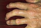 CONTEST Not Superior to PEST Questionnaire for Diagnosing Psoriatic Arthritis CONTEST Not Superior to PEST Questionnaire for Diagnosing Psoriatic Arthritis