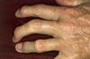 Ixekizumab Compared With Adalimumab in Head-to-Head PsA Study Ixekizumab Compared With Adalimumab in Head-to-Head PsA Study